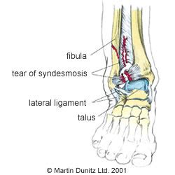 test for interosse membrane tear|Syndesmotic ankle injury (high ankle sprain) .